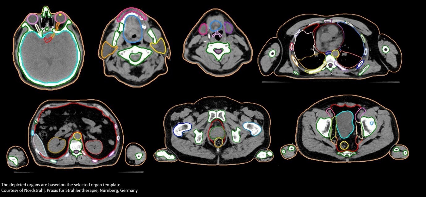 Radiotherapie